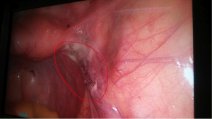 Interior de la pelvis tras haber resecado el ovario izdo de una paciente BRCA (en la foto se se puede observar claramente el lecho quirúrgico). 